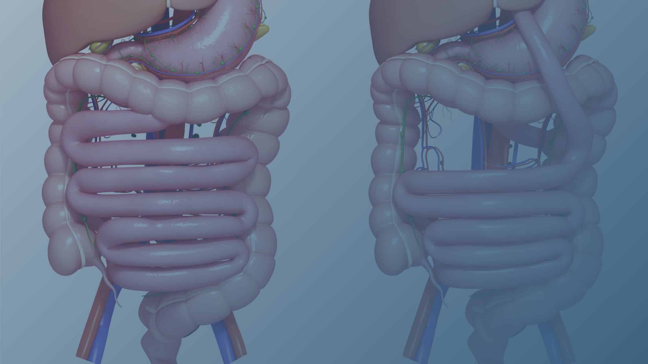 Ilustração comparativa de dois tipos de cirurgia bariátrica: à esquerda, o estômago e intestino normais; à direita, a técnica de bypass gástrico, com uma parte do estômago isolada e o intestino reencaminhado.